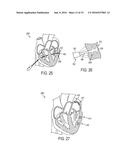 Devices and Methods for Occluding or Promoting Fluid Flow diagram and image