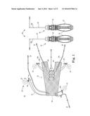 METHOD OF FIXATING AN IMPLANTABLE MATERIAL IN A PATIENT diagram and image