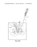 METHOD OF FIXATING AN IMPLANTABLE MATERIAL IN A PATIENT diagram and image