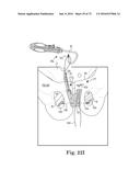 METHOD OF FIXATING AN IMPLANTABLE MATERIAL IN A PATIENT diagram and image