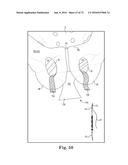 METHOD OF FIXATING AN IMPLANTABLE MATERIAL IN A PATIENT diagram and image