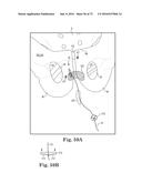 METHOD OF FIXATING AN IMPLANTABLE MATERIAL IN A PATIENT diagram and image