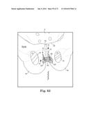 METHOD OF FIXATING AN IMPLANTABLE MATERIAL IN A PATIENT diagram and image