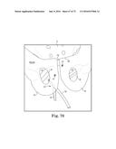 METHOD OF FIXATING AN IMPLANTABLE MATERIAL IN A PATIENT diagram and image