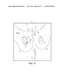 METHOD OF FIXATING AN IMPLANTABLE MATERIAL IN A PATIENT diagram and image