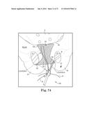 METHOD OF FIXATING AN IMPLANTABLE MATERIAL IN A PATIENT diagram and image