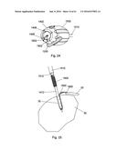 IMPLANT PLACEMENT SYSTEMS, DEVICES AND METHODS diagram and image