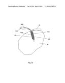 IMPLANT PLACEMENT SYSTEMS, DEVICES AND METHODS diagram and image