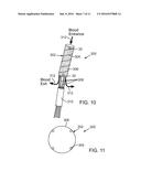 PERFUSION DEVICE FOR TREATING AN INJURED BLOOD VESSEL diagram and image