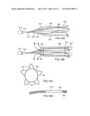 PERFUSION DEVICE FOR TREATING AN INJURED BLOOD VESSEL diagram and image