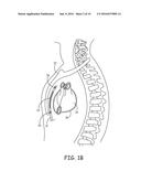 EXTRAVASCULAR IMPLANT TOOLS UTILIZING A BORE-IN MECHANISM AND IMPLANT     TECHNIQUES USING SUCH TOOLS diagram and image