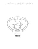 EXTRAVASCULAR IMPLANT TOOLS UTILIZING A BORE-IN MECHANISM AND IMPLANT     TECHNIQUES USING SUCH TOOLS diagram and image