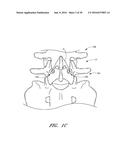 METHOD AND APPARATUS FOR SPINAL STABILIZATION diagram and image