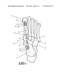 Method and Apparatus for Repairing the Mid-Foot Region Via and     Intramedullary Nail diagram and image