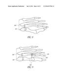 BONE PLATE FOR REDUCING ANGULAR BONE DEFORMITY AND METHOD OF USING diagram and image