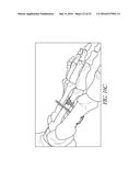 BONE PLATE FOR REDUCING ANGULAR BONE DEFORMITY AND METHOD OF USING diagram and image