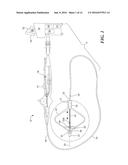 CONTRAST AGENT TO ASSESS QUALITY OF OCCLUSION THROUGH IMPEDANCE     MEASUREMENT diagram and image