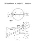 CONTRAST AGENT TO ASSESS QUALITY OF OCCLUSION THROUGH IMPEDANCE     MEASUREMENT diagram and image