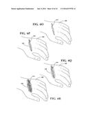 MATERIAL DEPOSITION DEVICE AND METHOD OF USE diagram and image