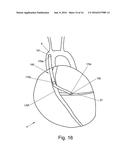 Graft Devices and Methods of Fabrication diagram and image