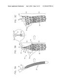 ENDOVASCULAR FENESTRATED STENT-GRAFTING diagram and image