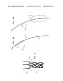 ENDOVASCULAR FENESTRATED STENT-GRAFTING diagram and image