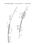 ENDOVASCULAR FENESTRATED STENT-GRAFTING diagram and image