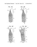 ENDOVASCULAR FENESTRATED STENT-GRAFTING diagram and image