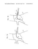 ENDOVASCULAR FENESTRATED STENT-GRAFTING diagram and image