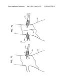 ENDOVASCULAR FENESTRATED STENT-GRAFTING diagram and image