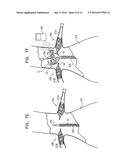 ENDOVASCULAR FENESTRATED STENT-GRAFTING diagram and image