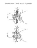 ENDOVASCULAR FENESTRATED STENT-GRAFTING diagram and image