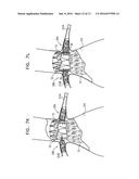 ENDOVASCULAR FENESTRATED STENT-GRAFTING diagram and image