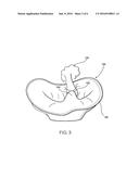 INTRACARDIAC DEVICE TO CORRECT MITRAL REGURGITATION diagram and image