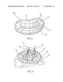 INTRACARDIAC DEVICE TO CORRECT MITRAL REGURGITATION diagram and image