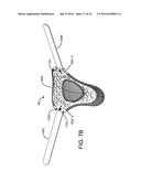 ADJUSTABLE CERVICAL COLLAR diagram and image