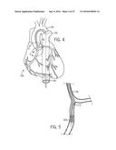 ROBOTIC CATHETER SYSTEM diagram and image