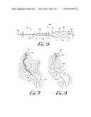 ANCHOR DEVICE FOR USE WITH CATHETERS diagram and image