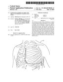 EXTRAVASCULAR IMPLANT TOOLS AND IMPLANT TECHNIQUES UTILIZING SUCH TOOLS diagram and image