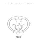 EXTRAVASCULAR IMPLANT TOOLS AND IMPLANT TECHNIQUES UTILIZING SUCH TOOLS diagram and image