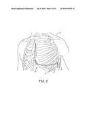 EXTRAVASCULAR IMPLANT TOOLS AND IMPLANT TECHNIQUES UTILIZING SUCH TOOLS diagram and image