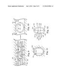 SYSTEMS AND METHODS FOR FIXATING TRANSVENOUSLY IMPLANTED MEDICAL DEVICES diagram and image