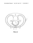 EXTRAVASCULAR IMPLANTABLE ELECTRICAL LEAD HAVING UNDULATING CONFIGURATION diagram and image