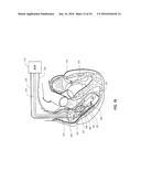 ATRIAL FIBRILLATION TREATMENT SYSTEMS AND METHODS diagram and image