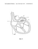 ATRIAL FIBRILLATION TREATMENT SYSTEMS AND METHODS diagram and image