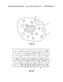 ATRIAL FIBRILLATION TREATMENT SYSTEMS AND METHODS diagram and image