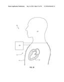 ATRIAL FIBRILLATION TREATMENT SYSTEMS AND METHODS diagram and image