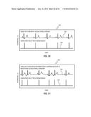 ATRIAL FIBRILLATION TREATMENT SYSTEMS AND METHODS diagram and image