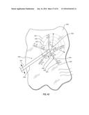 ATRIAL FIBRILLATION TREATMENT SYSTEMS AND METHODS diagram and image