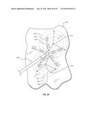 ATRIAL FIBRILLATION TREATMENT SYSTEMS AND METHODS diagram and image